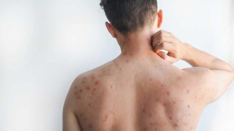 Sarampión deja su primera víctima mortal en CDMX